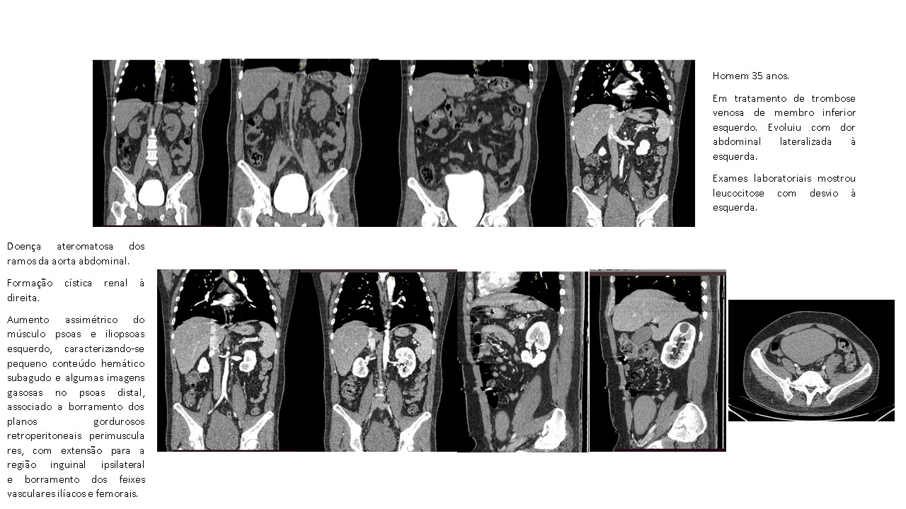 Abscesso PSOAS