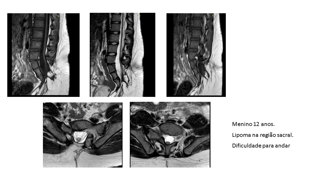 Lipoma na região sacral.