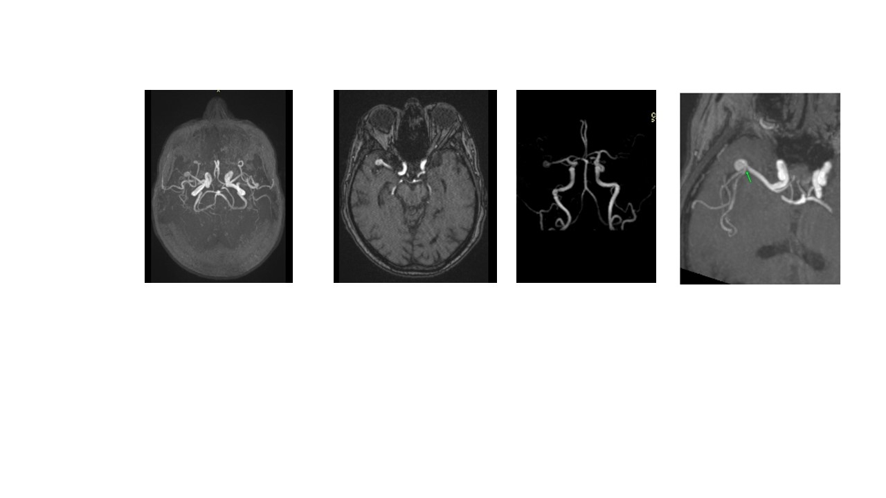 Aneurisma Intracraniano