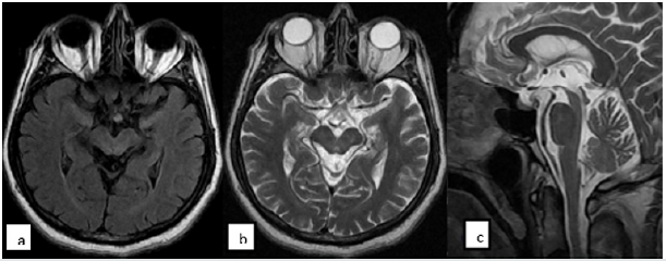 Paralisia supranuclear progressive.(Steele-Richardson-Olszewski syndrome)