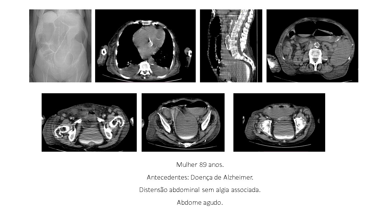 Distensão Abdominal