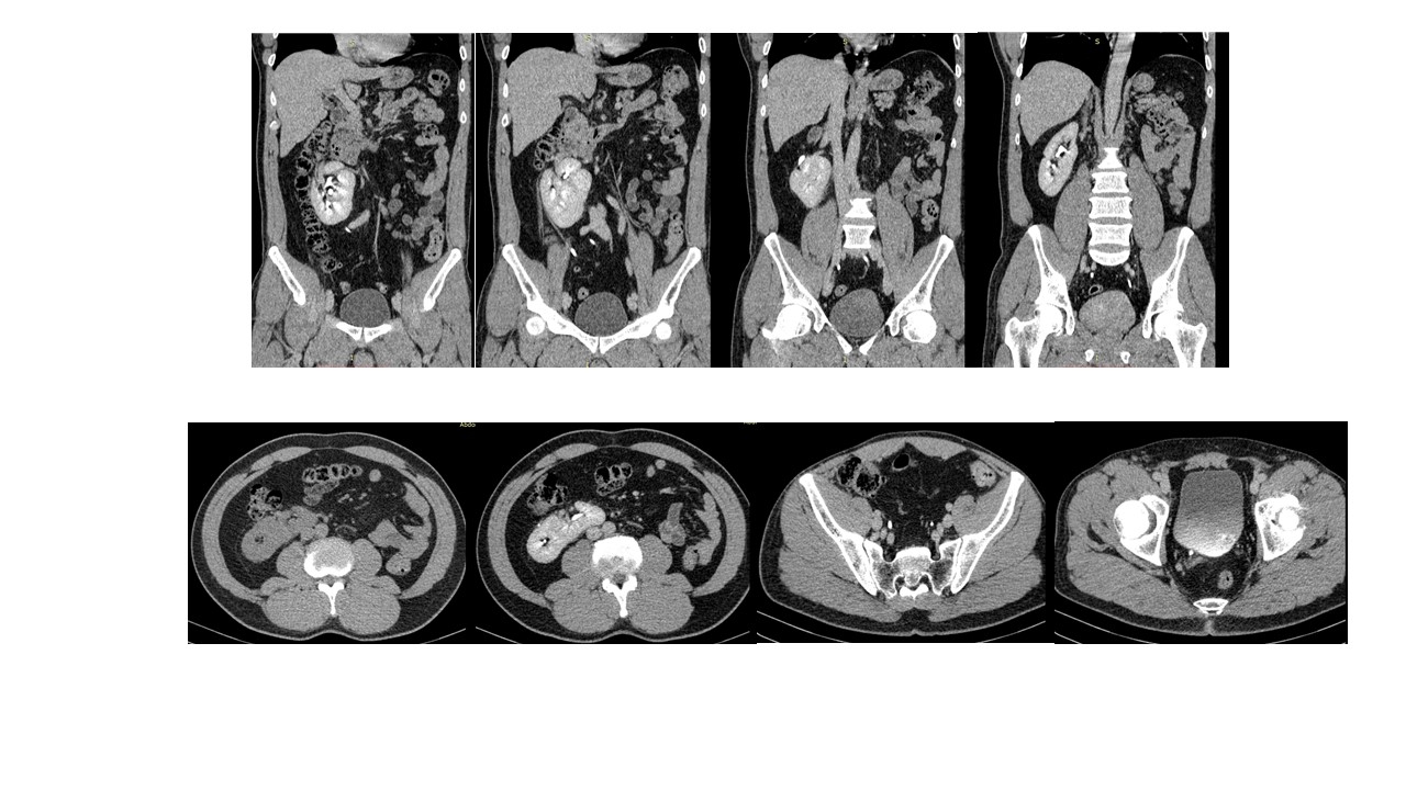 Ectopia Renal