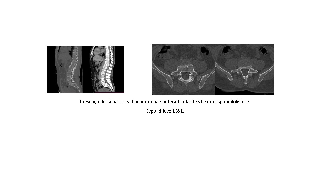 Espondilólise da Coluna Lombar