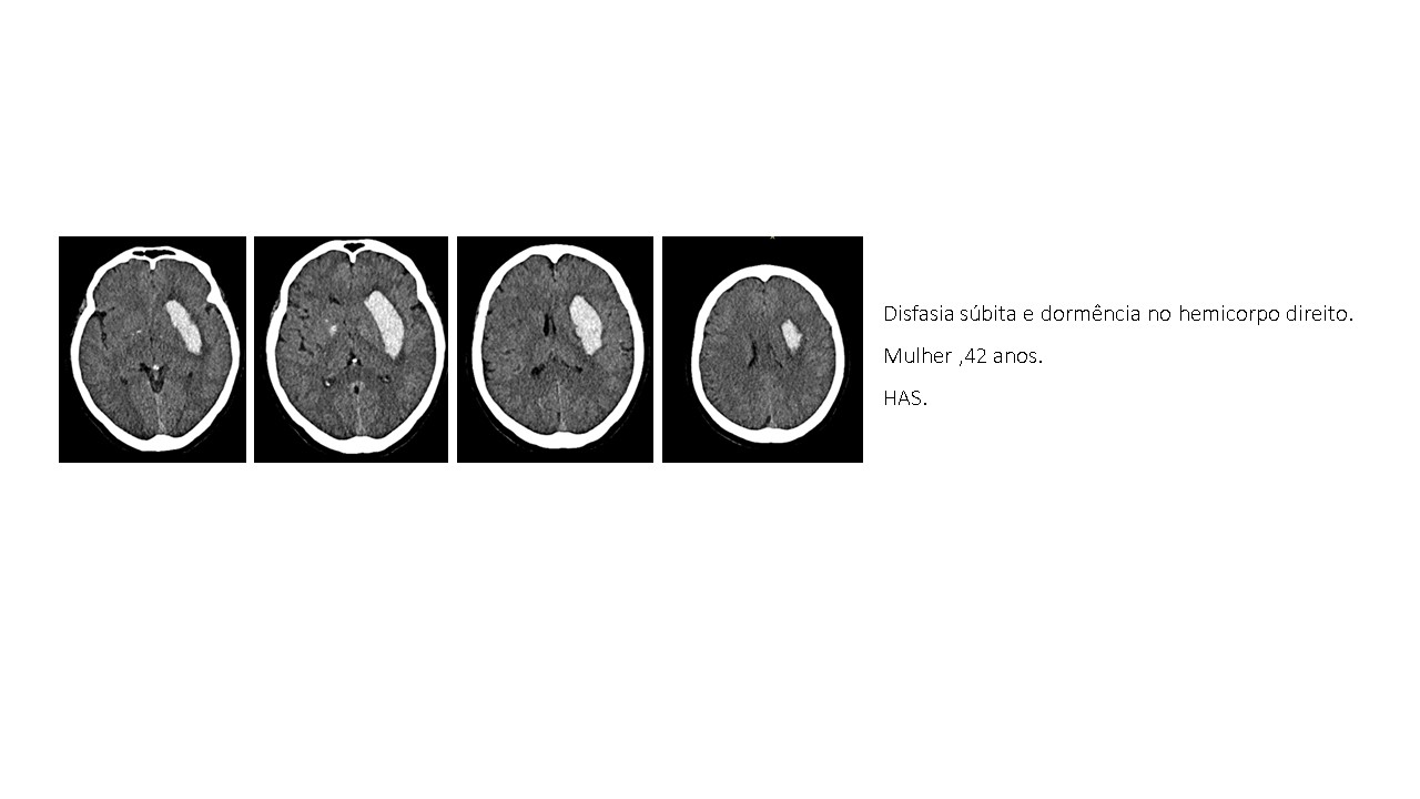 Hematoma Ganglionico