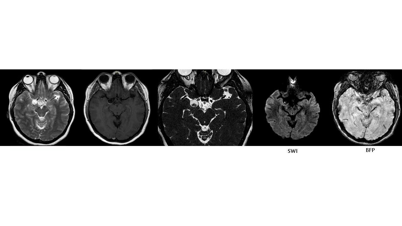 Neurocisticercos