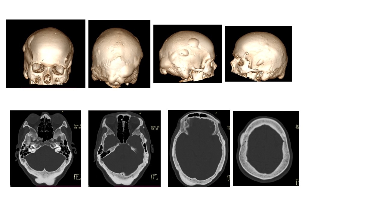 Osteoma Calota Craninana