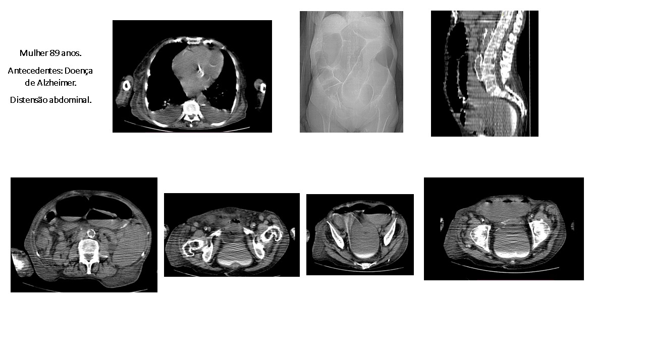 Pseudo Obstrução Instestinal