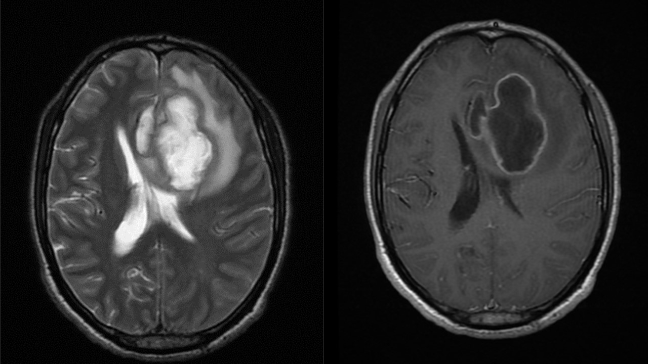 Abscesso Cerebral