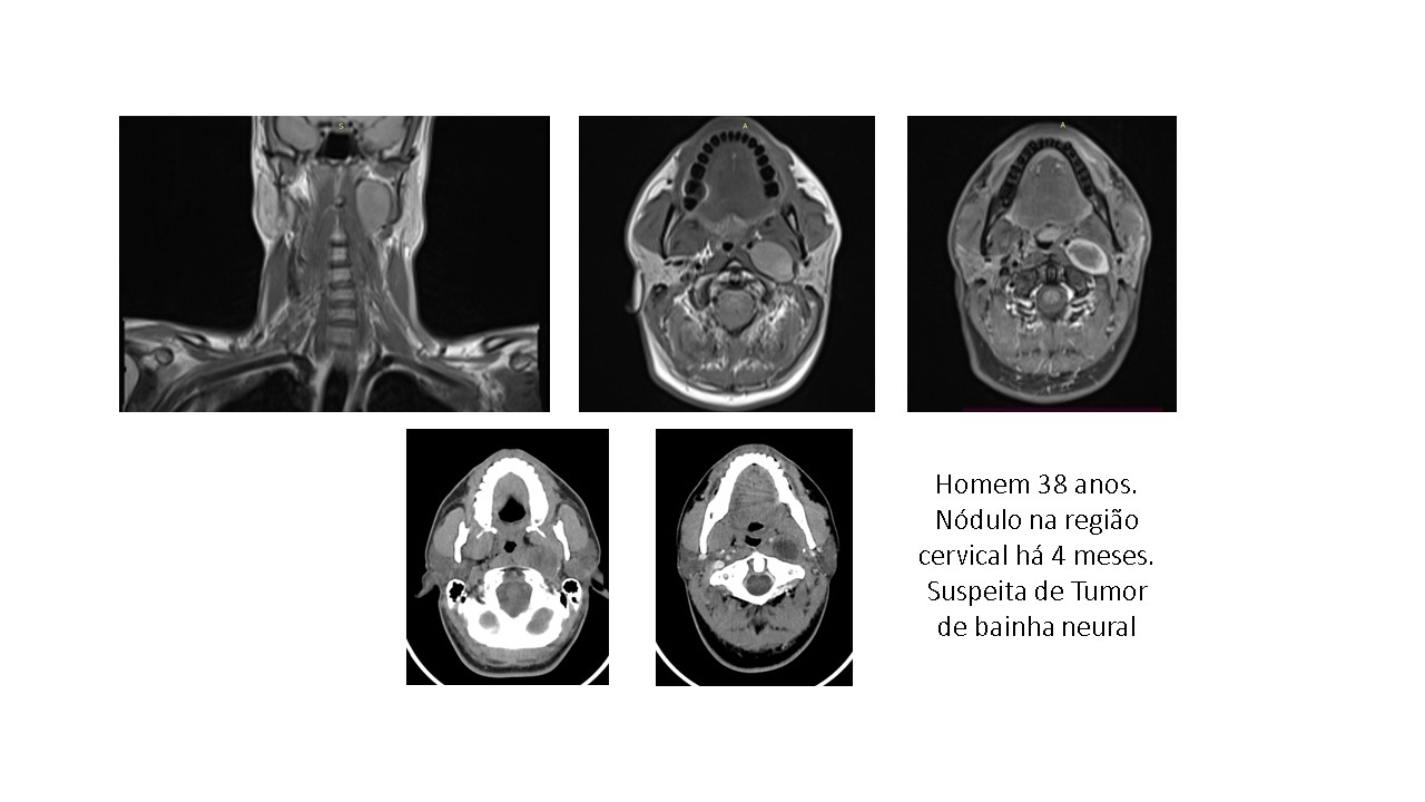 Tumor da Bainha Neural